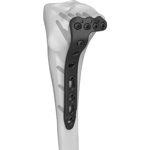 Placa de compresión para tibia - 301023 series - Boneunion Medical - porción proximal / lateral / bloqueada