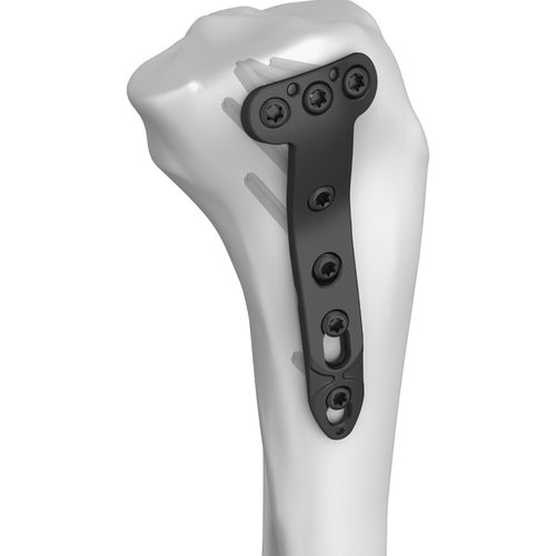 Placa de compresión para tibia - 301005 series - Boneunion Medical - porción proximal / porción medial / bloqueada