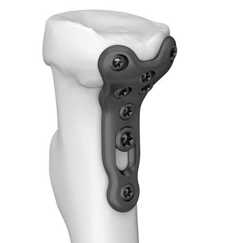 Placa de compresión para radio - 301178 series - Boneunion Medical - para cóndilo humeral / porción proximal / bloqueada