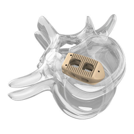 Caja intersomática lumbar - 4000 series - Aplus Biotechnology - vía posterior / de PEEK