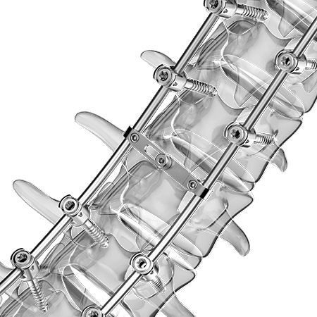 Sistema de osteosíntesis toracolumbar - Aplus Biotechnology - vía posterior / para adulto