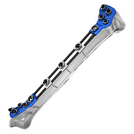 Fijador externo para tibia - Aplus Biotechnology - tubular / pediátrico