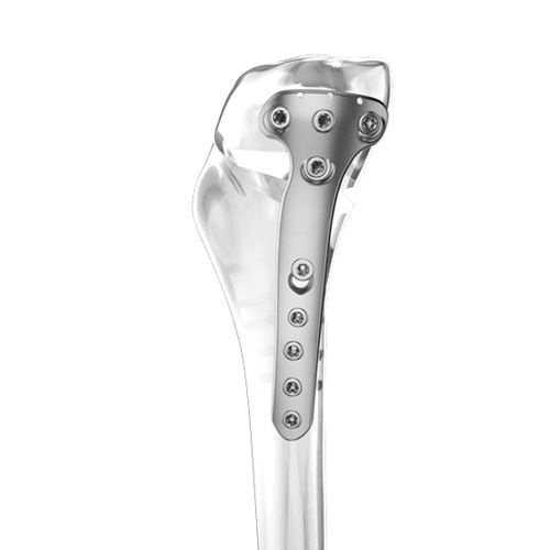 Placa de osteotomía para tibia - Aplus Biotechnology - porción proximal / bloqueada / de titanio