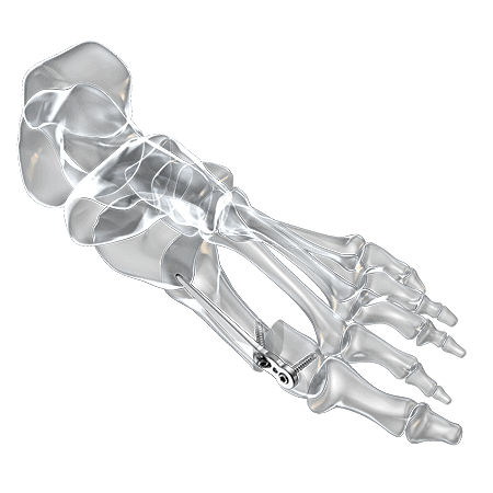 Placa de osteotomía para hallux valgus - 1600-1320-01 - Aplus Biotechnology - porción distal / bloqueada / de titanio