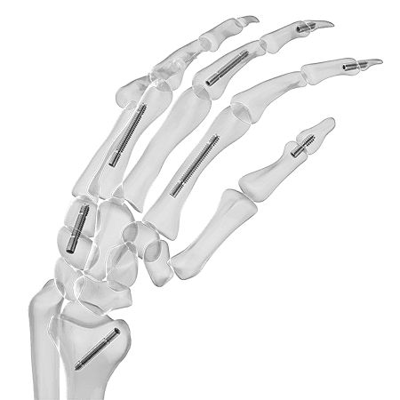 Tornillo de artrodesis para carpo - Aplus Biotechnology - para falange de la mano / sin cabeza