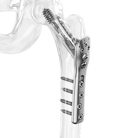 Placa de compresión para trocánter - 2500-0020:0021 series - Aplus Biotechnology - para cabeza femoral / porción proximal / bloqueada