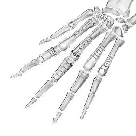 Placa de compresión para falange de la mano - 1600 series - Aplus Biotechnology - para pie / para fragmentos óseos pequeños / para metacarpo