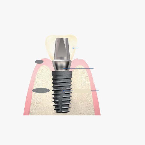 Pilar para implante de titanio - Snucone Co.,Ltd - interno / recto / cementado