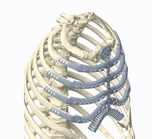 Prótesis costal para la reconstrucción tras resección de osteosarcoma - Osteobionix