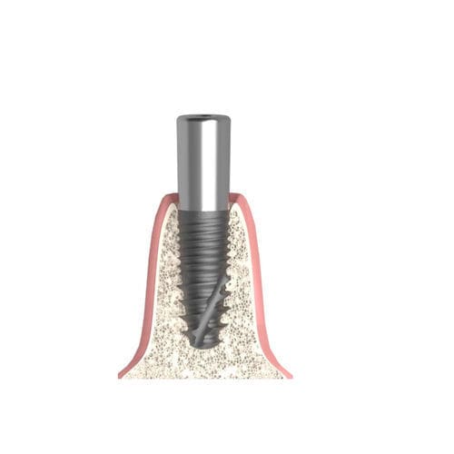 Pilar de cicatrización cilíndrico - Actival - Bionika Medline Kft. - interno / estrecho / para clínica dental