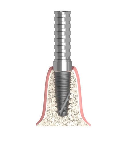 Pilar para implante cilíndrico cónico - Actival - Bionika Medline Kft. - de titanio / interno / de tornillo