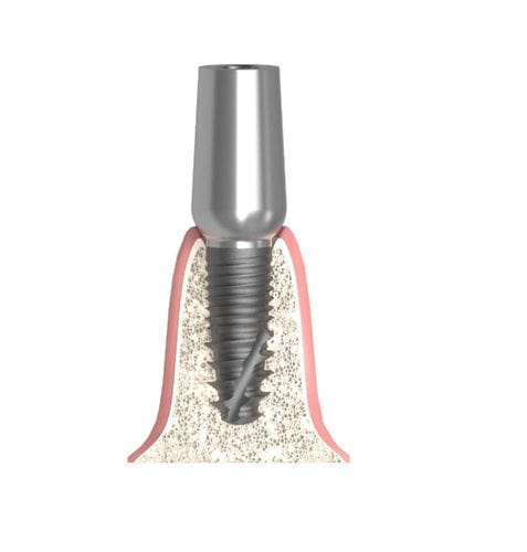 Pilar para implante cilíndrico - Actival - Bionika Medline Kft. - de titanio / interno / recto