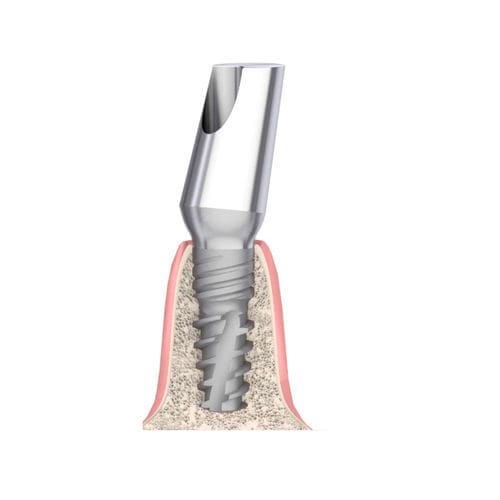 Pilar para implante cónico - Actival - Bionika Medline Kft. - de titanio / interno / en ángulo