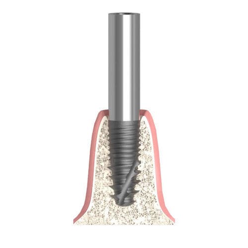 Pilar para implante cilíndrico - Actival - Bionika Medline Kft. - de titanio / interno / recto