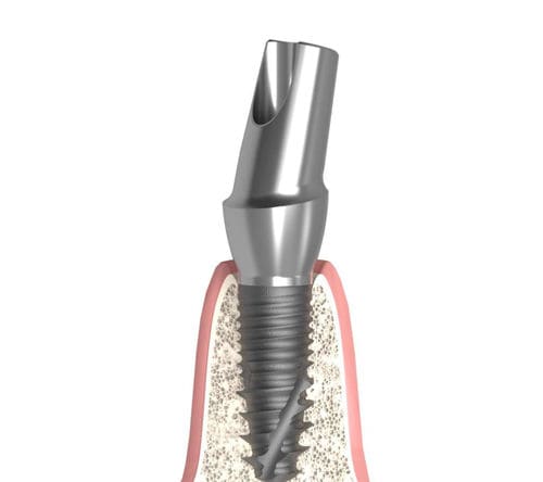 Pilar para implante cónico - Actival - Bionika Medline Kft. - de titanio / hexagonal / interno