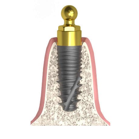 Pilar para implante cilíndrico - Actival - Bionika Medline Kft. - tipo bola / recto / para clínica dental