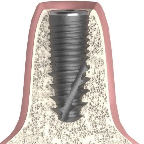 Implante dental cilíndrico cónico - UNIFORM - Bionika Medline Kft. - de titanio / hexagonal / interno