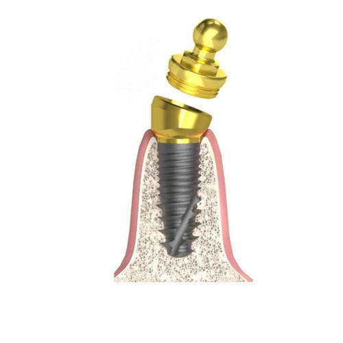 Pilar para implante cilíndrico cónico - Actival - Bionika Medline Kft. - cónico / interno / tipo bola