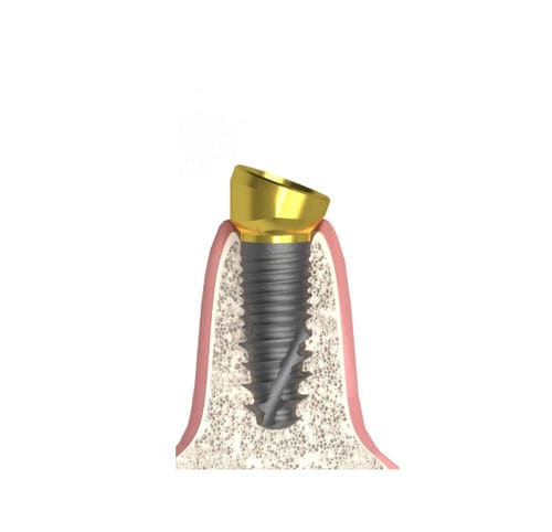 Pilar para implante cilíndrico cónico - Actival - Bionika Medline Kft. - de titanio / cónico / interno