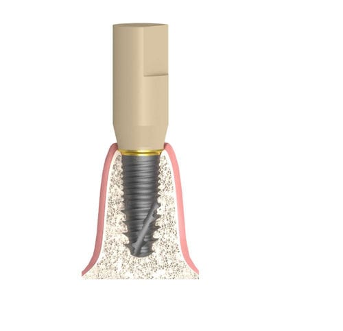 Cuerpo de exploración intraoral - Bioplant - Bionika Medline Kft.