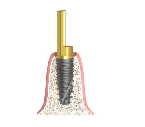 Pilar para implante cilíndrico - Bioplant - Bionika Medline Kft. - de titanio / hexagonal / interno