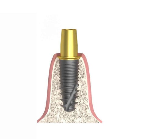 Pilar para implante cilíndrico - Bioplant - Bionika Medline Kft. - de titanio / hexagonal / interno