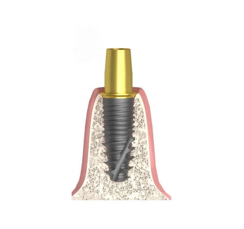 Pilar para implante cilíndrico cónico - UNIFORM DIO® UF - Bionika Medline Kft. - de titanio / interno / recto