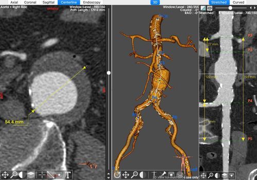 Software de planificación - EndoSize® - Therenva - de intercambio / de planificación preoperatoria / de importación
