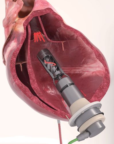 Dispositivo de asistencia ventricular para adulto - FLOWMAKER ® - FineHeart