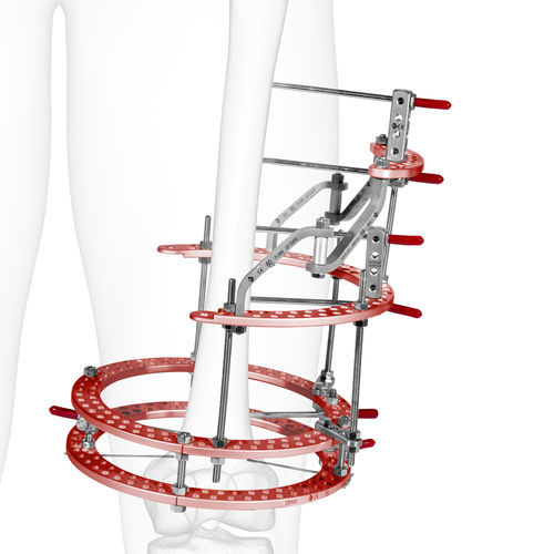 fijador externo para tibia - DIAL Medicali