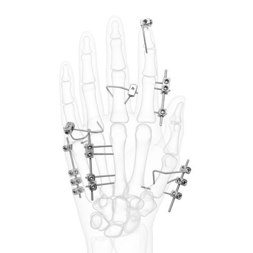 fijador externo para articulación metacarpofalángica - DIAL Medicali