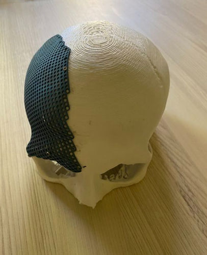 Implante craneal a medida - hb ortho