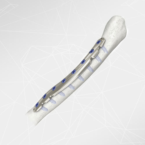 Placa de compresión para clavícula - LOQTEQ® 2.7 - aap Implantate - lateral / porción medial / bloqueada