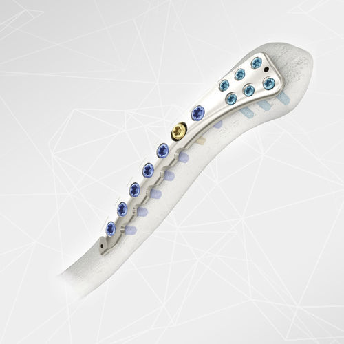 Placa de compresión para clavícula - LOQTEQ® 2.7 - aap Implantate - lateral / bloqueada / metálica