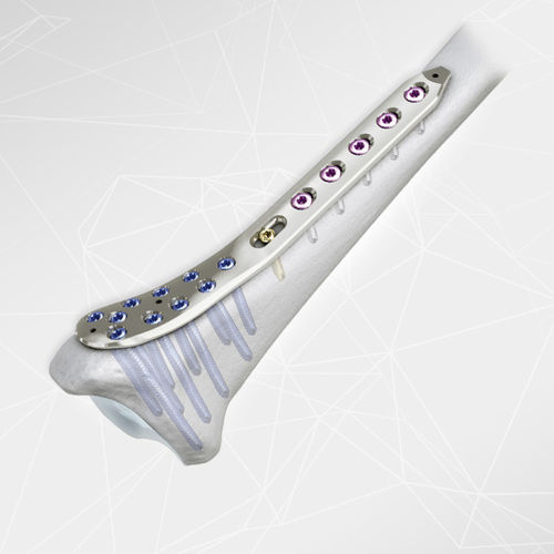 Placa de compresión para tibia -  LOQTEQ® 3.5 - aap Implantate - porción distal / porción medial / bloqueada