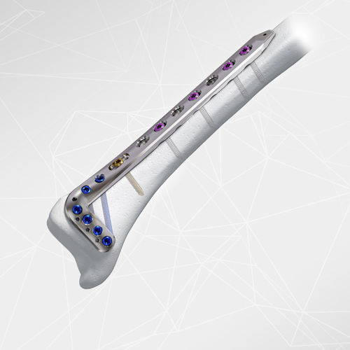 Placa de compresión para tibia -  LOQTEQ® 3.5 - aap Implantate - porción distal / anterolateral / bloqueada