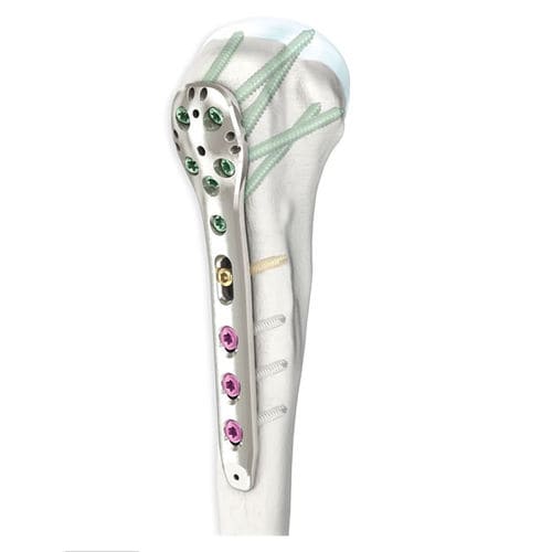 Placa de compresión para húmero - LOQTEQ® 3.5 - aap Implantate - porción proximal / bloqueada / metálica