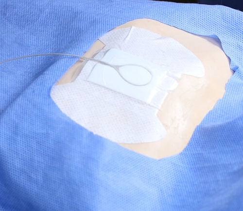 Fijador de catéter para catéter intravenoso - Lock Plus - ACE Medical   - en tronco / adhesivo