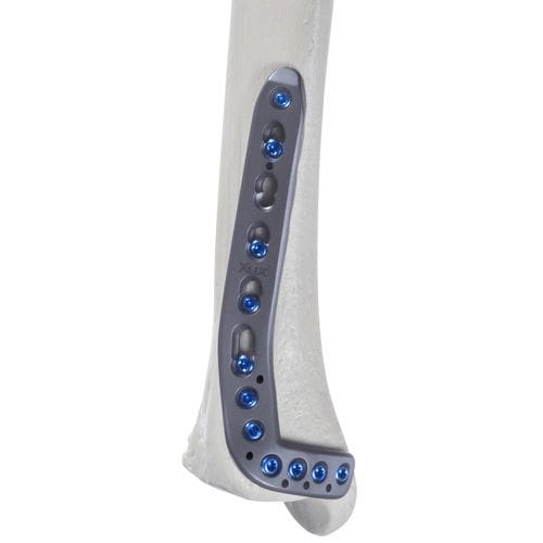 Placa de compresión para tibia - 10-55 series - AF Medical   - porción distal / anterolateral / bloqueada