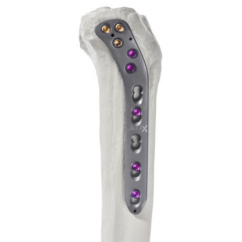Placa de compresión para tibia - 10-62603 - AF Medical   - porción proximal / lateral / bloqueada