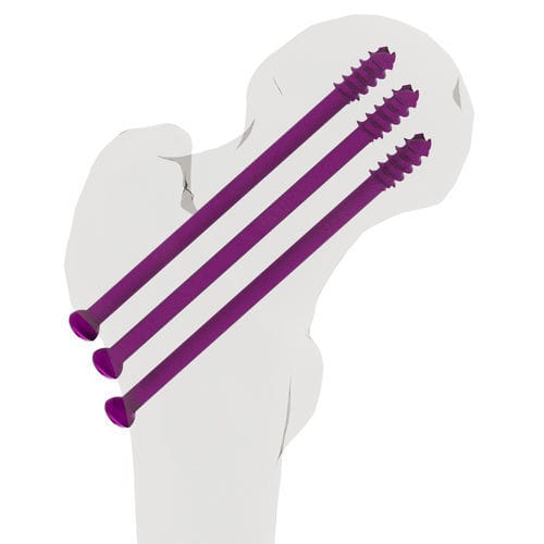 Tornillo de compresión ósea para muñeca - 15-02800 - AF Medical   - para tibia / para fémur / para fémur