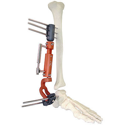 Fijador externo para tobillo - 567 - BAUMER  - tubular / para adulto