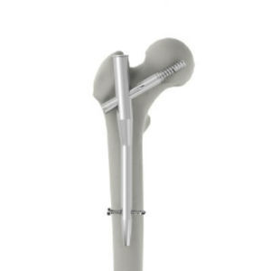 Clavo intramedular para fémur - INTERNA® PFN - BAUMER  - fijación proximal / metálico