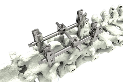 Tornillo pedicular para vértebra torácica, lumbar - M10-Ia - Waston medical - poliaxial / monoaxial / de titanio