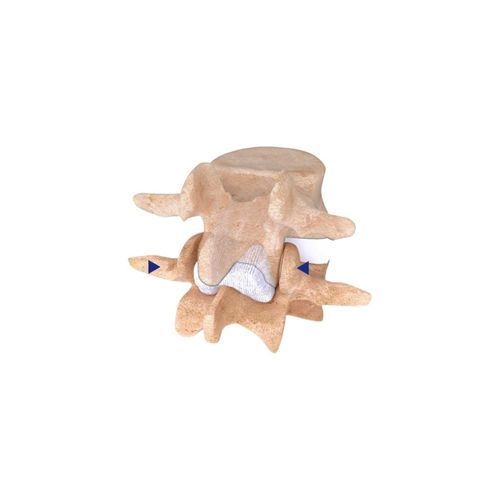 Implante vertebral interespinoso lumbar - IntraSPINE&reg; - Cousin Biotech