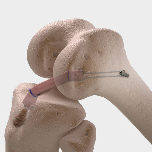 Prótesis de ligamento ligamento cruzado anterior - CorTTape® - FH Orthopedics - ligamento cruzado posterior / sintética