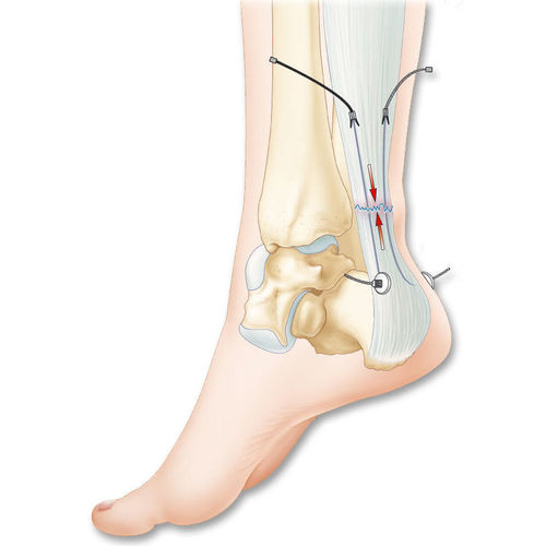 Prótesis de ligamento tendón calcáneo - Tenolig® - FH Orthopedics - sintética