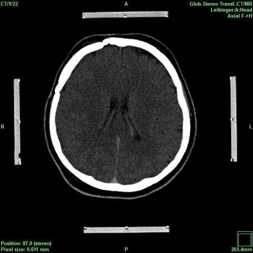 Software de planificación - iPS - inomed Medizintechnik - de verificación / para neurocirugía / para neurocirugía estereotáxica