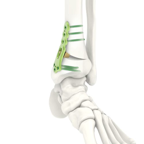 Placa de osteotomía para tibia - ARIX 3.5 - Jeil Medical Corporation - porción distal / bloqueada / de titanio