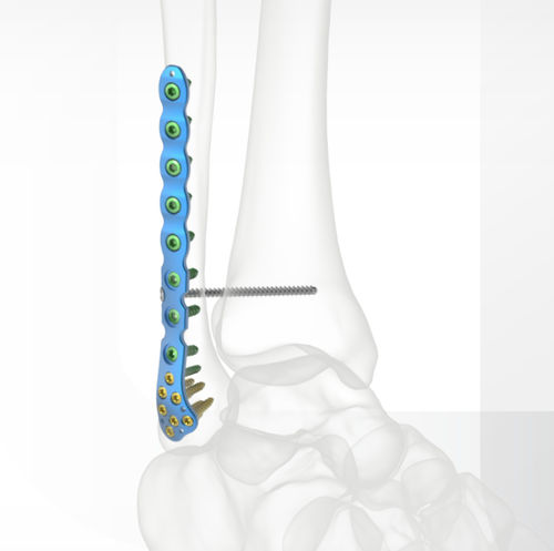 Placa de compresión para peroné - Jeil Medical Corporation - porción distal / anterolateral / bloqueada